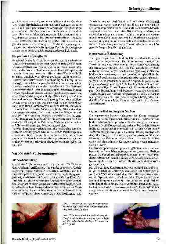 Vorschauseite 5: Plastische Hautdeckung und Narbenkorrekturen nach Verbrühungen und Verbrennungen