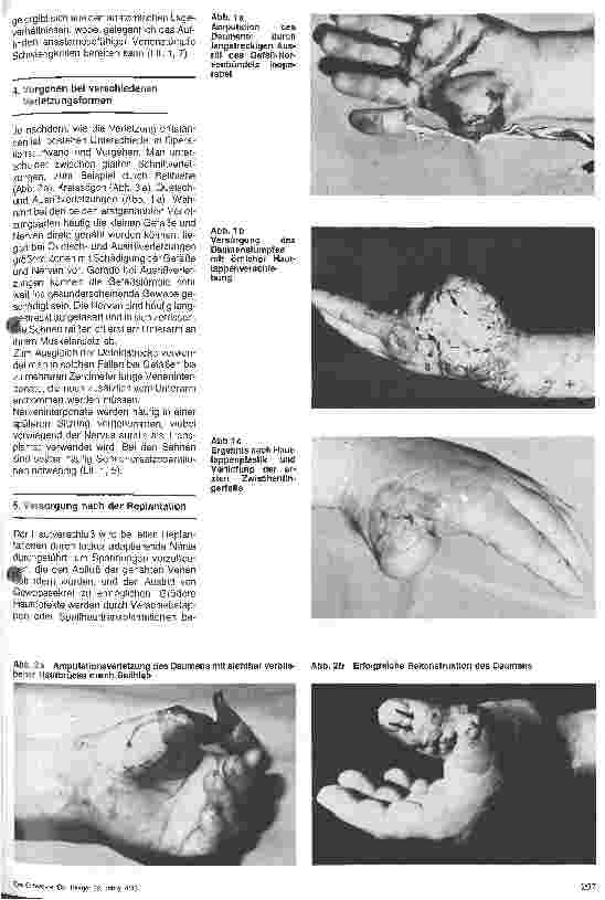 Vorschauseite 2: Aktuelle Aspekte der Handchirurgie nach Einführung der Mikrogefäßchirurgie