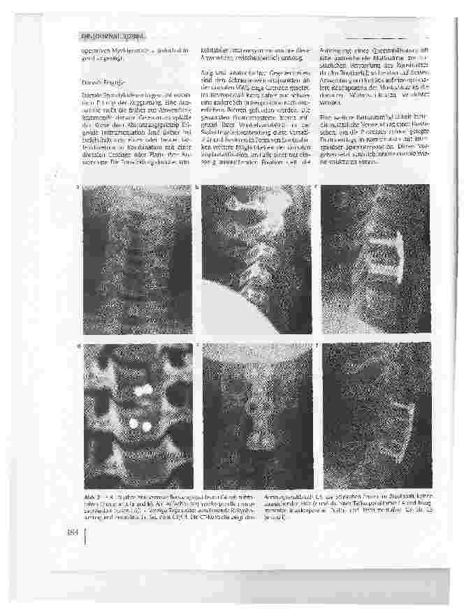 Vorschauseite 3: Lösungsmöglichkeiten nach fehlgeschlagenen Spondylodesen an der Halswirbelsäule