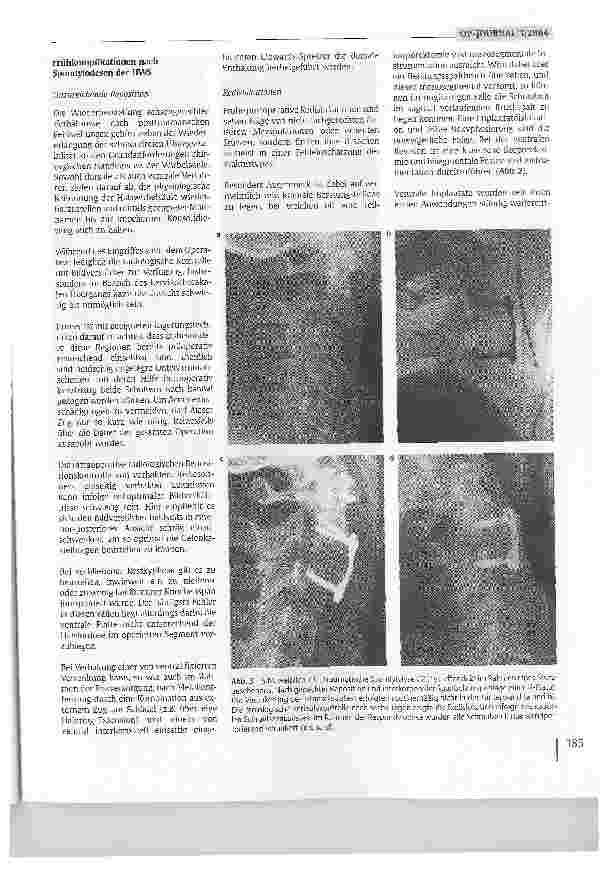 Vorschauseite 4: Lösungsmöglichkeiten nach fehlgeschlagenen Spondylodesen an der Halswirbelsäule