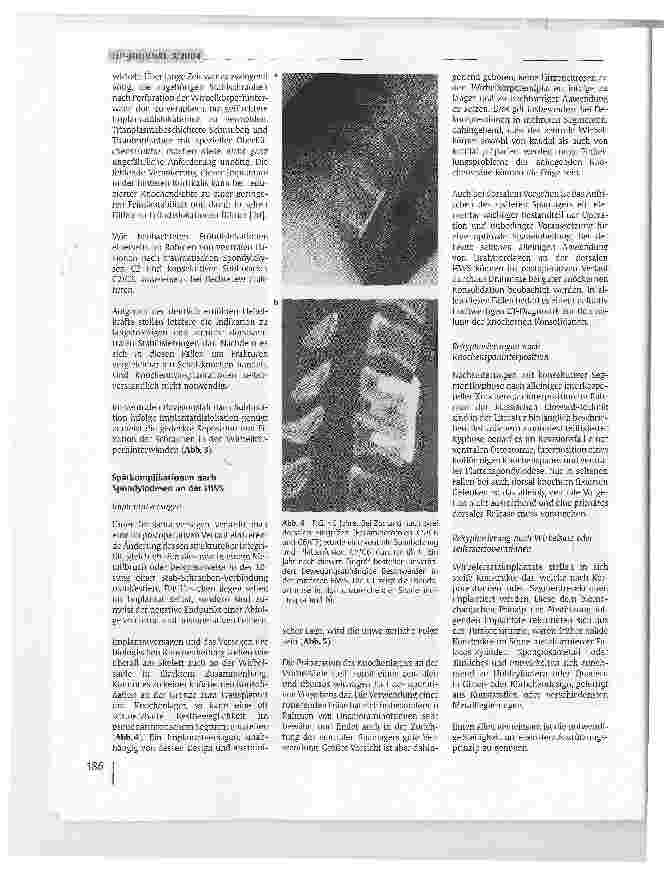 Vorschauseite 5: Lösungsmöglichkeiten nach fehlgeschlagenen Spondylodesen an der Halswirbelsäule