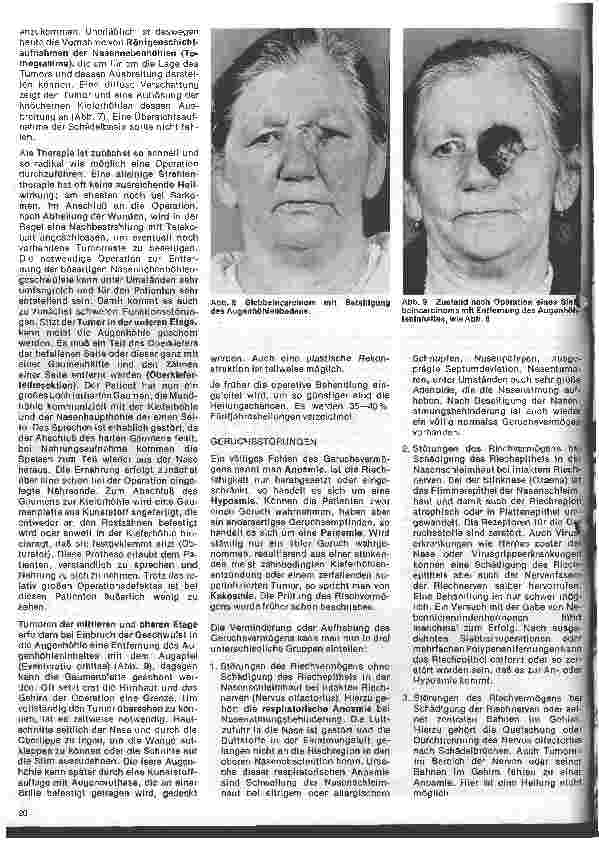 Vorschauseite 4: Einführung in die Hals - Nasen - Ohren - Heilkunde 12. Folge: Tumoren der Nasennebenhöhlen, Riechstörungen