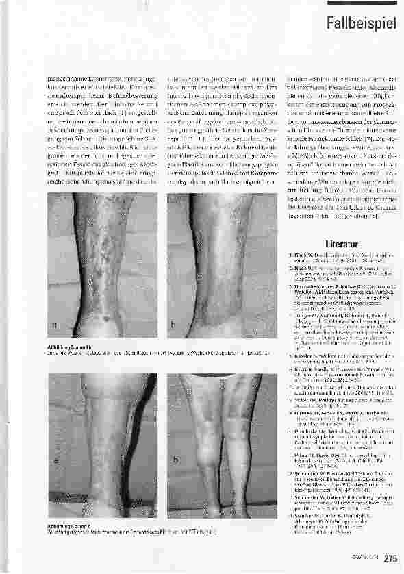 Vorschauseite 3: Operative Therapie des venösen Ulcus cruris