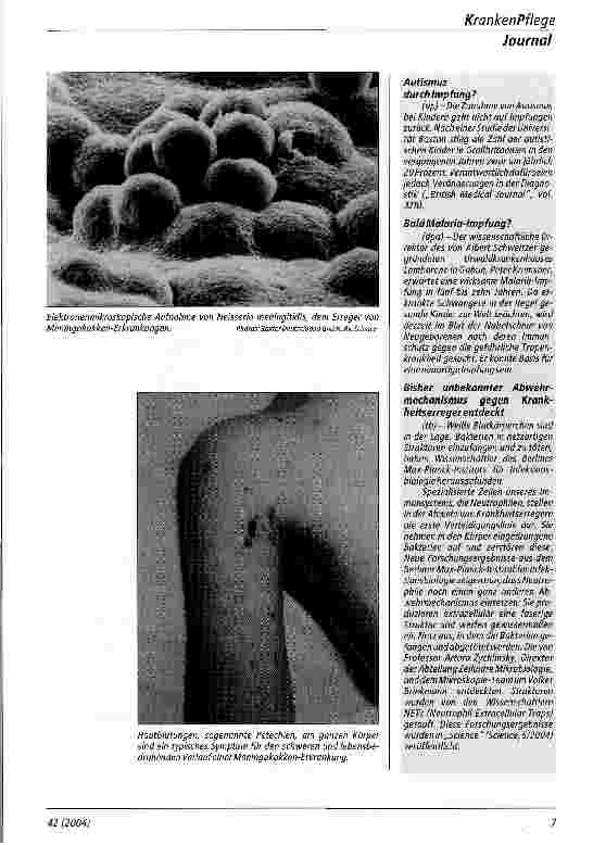 Vorschauseite 3: Bakterielle Meningitis