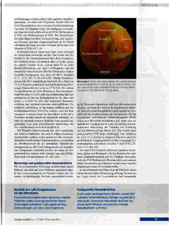 Vorschauseite 6: Rissbedingte Netzhautablösung -ein ophthalmologischer Notfall