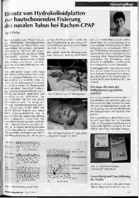 Vorschauseite 1: Einsatz von Hydrokolloidplatten zur hautschonenden Fixierung des nasalen Tubus bei Rachen-CPAP