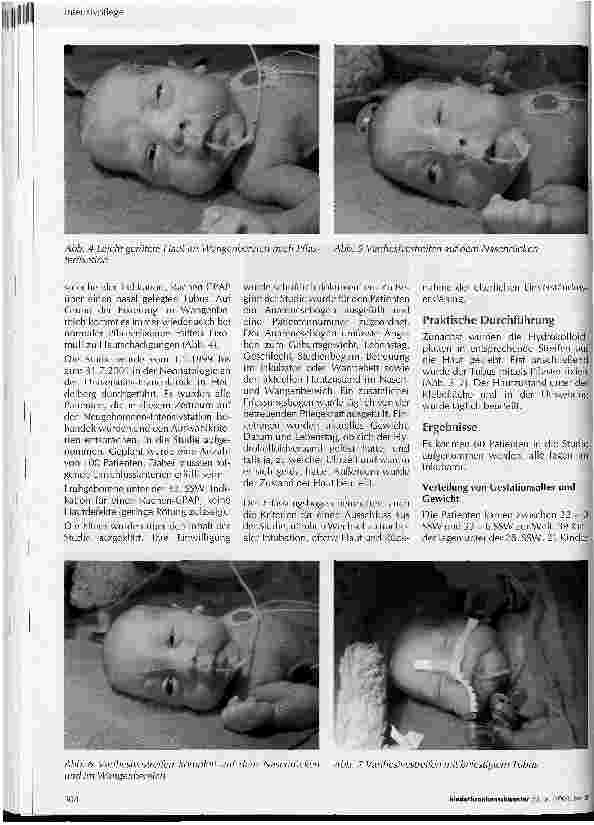 Vorschauseite 2: Einsatz von Hydrokolloidplatten zur hautschonenden Fixierung des nasalen Tubus bei Rachen-CPAP