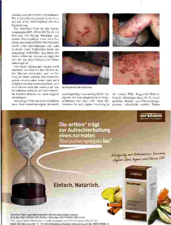 Vorschauseite 2: Herpes Zoster aus der Sicht der TEN