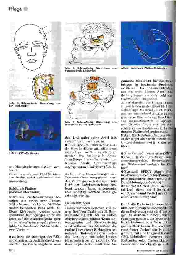 Vorschauseite 3: Epilepsie - Neurochirurgie 1. Teil: Medizinische Aspekte während des Intensivmonitorings