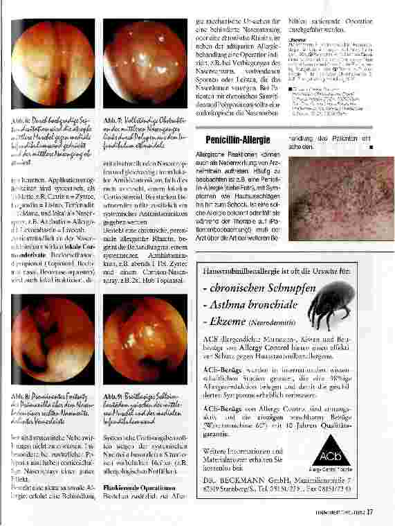 Vorschauseite 4: Allergische Reationen der Nase Diagnostik und Therapie