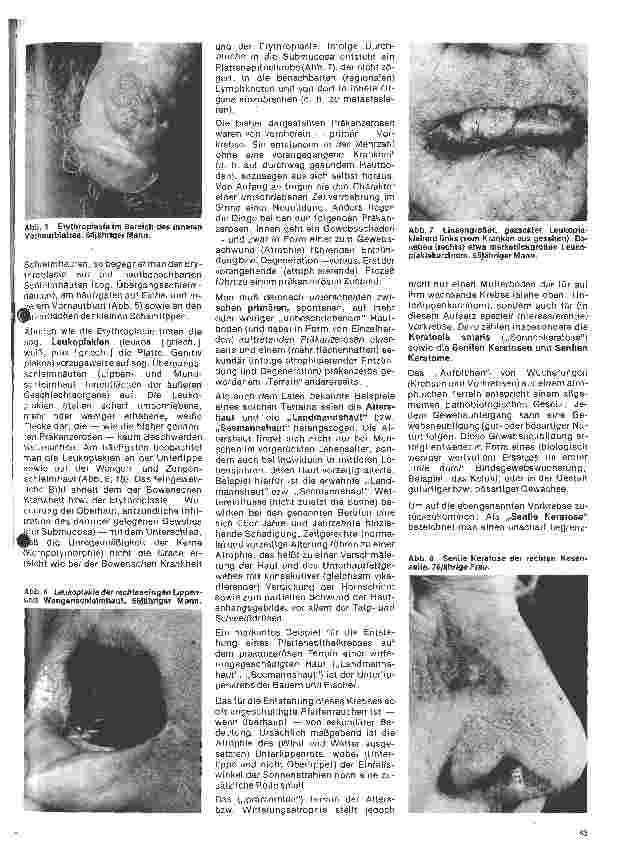 Vorschauseite 2: Arbeitsgebiete der modernen Dermatologie Hautpräkanzerosen bei Mann und Frau
