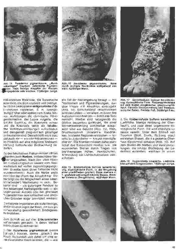 Vorschauseite 4: Arbeitsgebiete der modernen Dermatologie Hautpräkanzerosen bei Mann und Frau