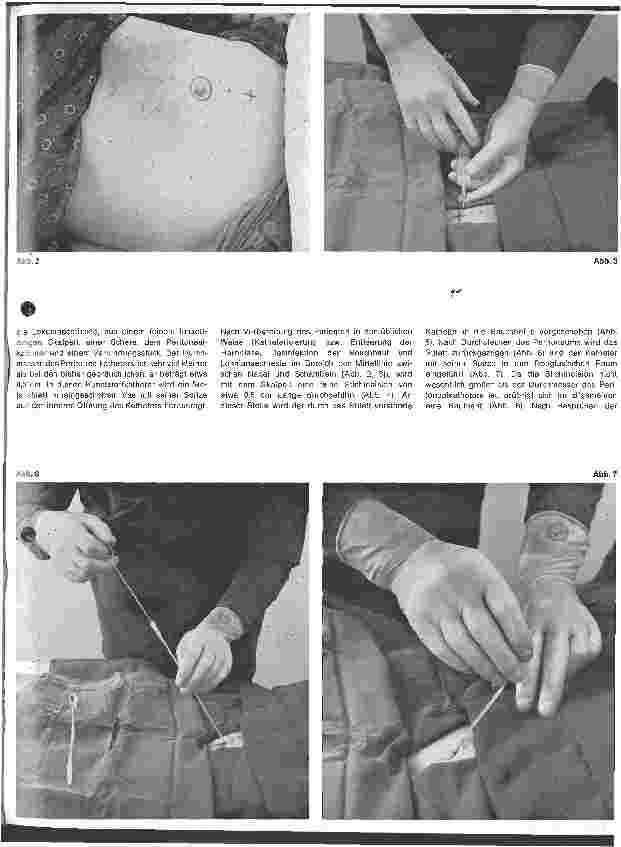 Vorschauseite 2: Peritonealdialyse