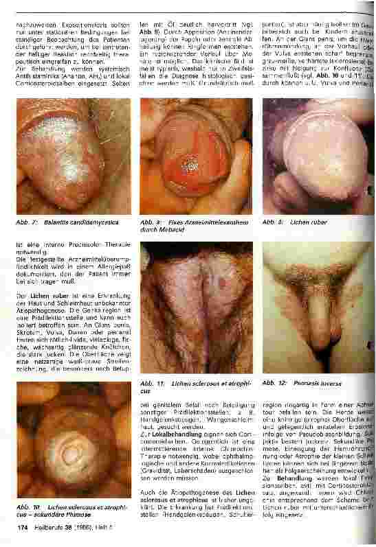 Vorschauseite 3: Diagnostik und Therapie bei Dermatosen im Genitalbereich