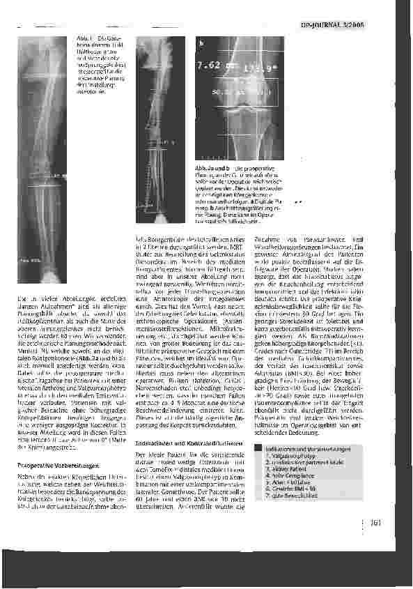 Vorschauseite 2: Die varisierende distale Femurosteotomiemit dem TomoFix-PIattenfixateur zur Behandlungder Valgusgonarthrose
