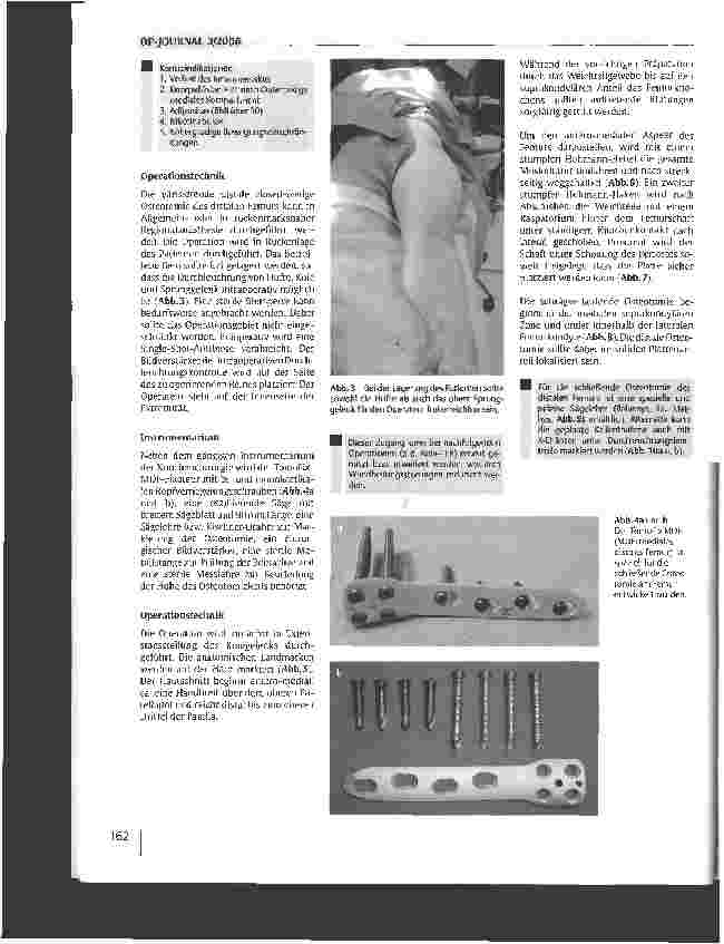 Vorschauseite 3: Die varisierende distale Femurosteotomiemit dem TomoFix-PIattenfixateur zur Behandlungder Valgusgonarthrose