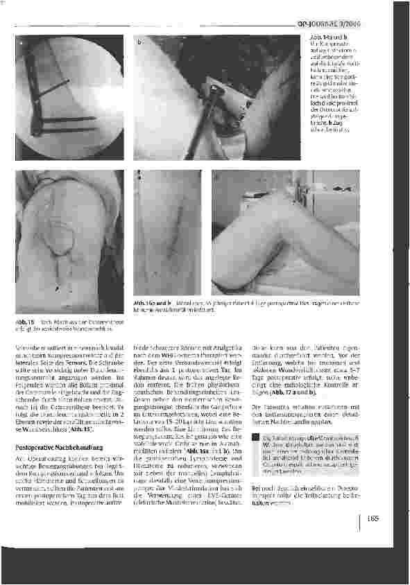 Vorschauseite 6: Die varisierende distale Femurosteotomiemit dem TomoFix-PIattenfixateur zur Behandlungder Valgusgonarthrose