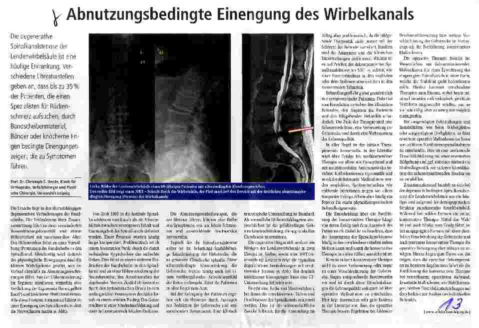Vorschauseite 1: Abnutzungsbedingte Einengung des Wirbelkanals