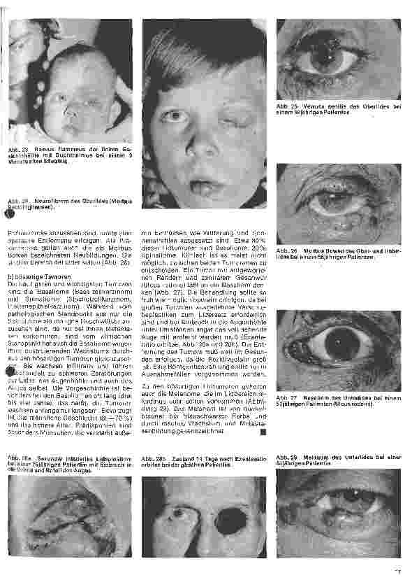 Vorschauseite 6: Einführung in die Augenheilkunde 4. Folge: Erkrankungen der Lider