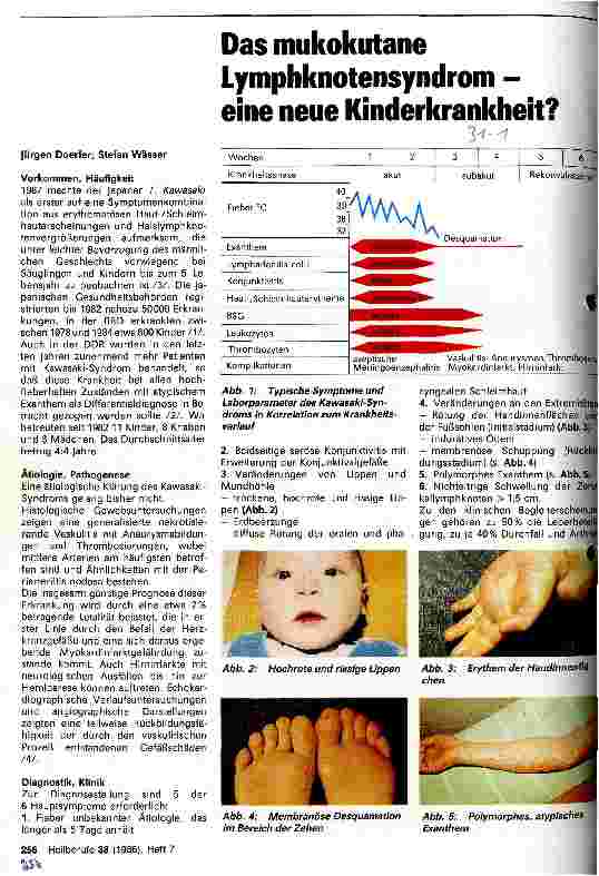 Vorschauseite 1: Das Mukokutane Lymphknotensyndrom - eine neue Kinderkrankheit?