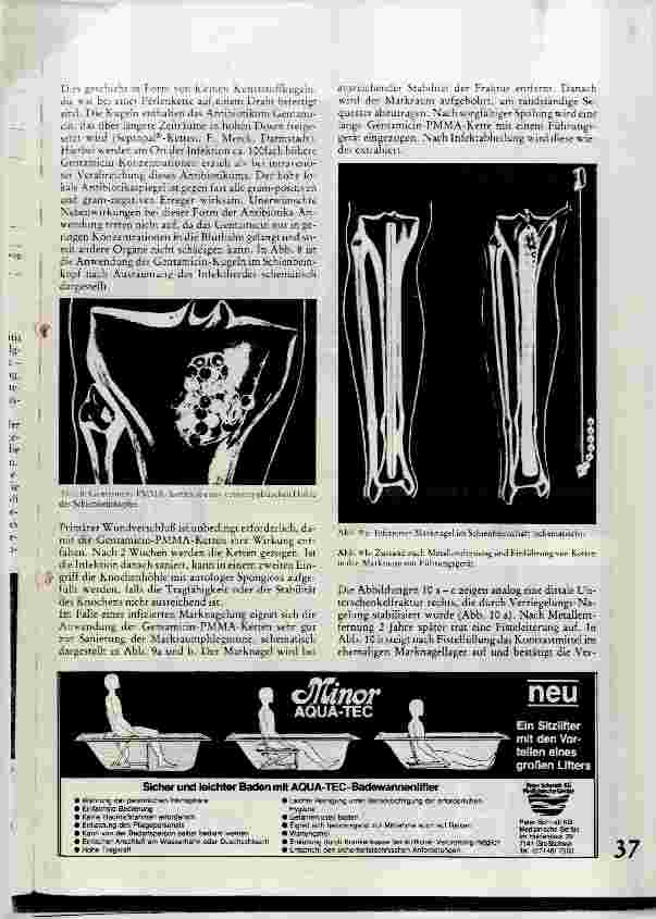 Vorschauseite 4: Klinik und Therapie der Osteomyelitis