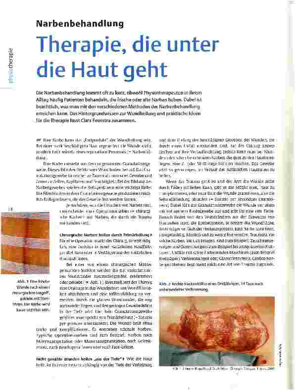 Vorschauseite 1: Narbenbehandlung Therapie, die unter die Haut geht