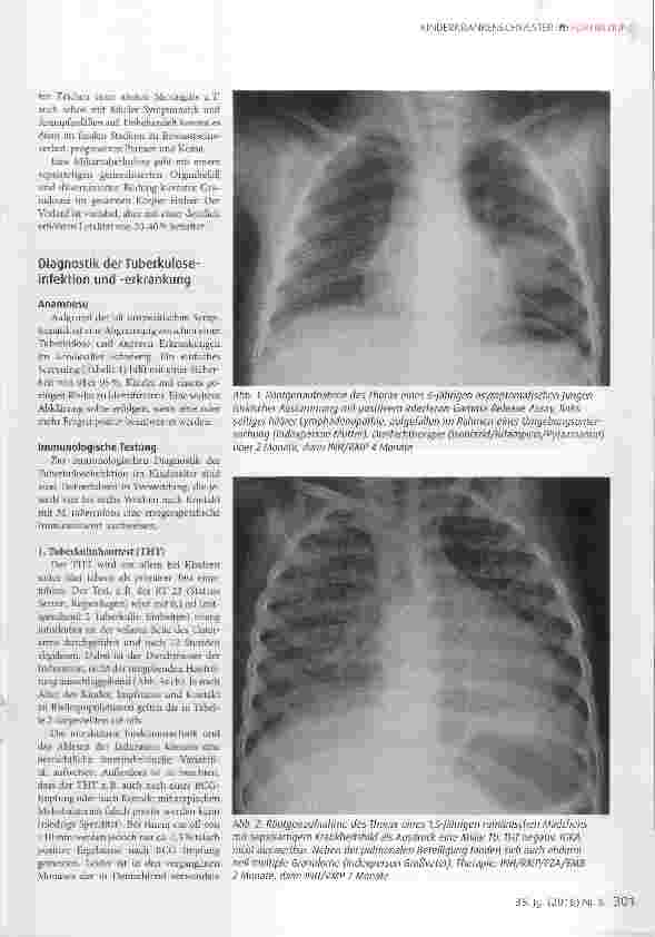 Vorschauseite 2: Tuberkulose im Kindesalter