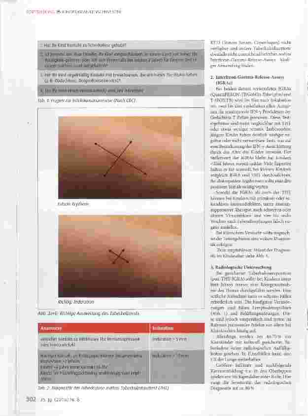 Vorschauseite 3: Tuberkulose im Kindesalter