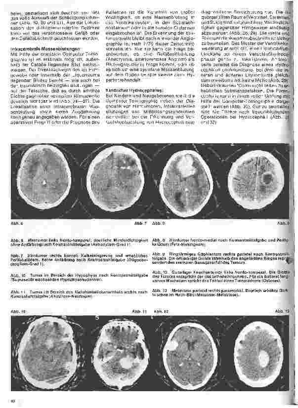 Vorschauseite 3: Themen aus der Neurochirurgie 3. Folge: Die craniale Computer-Tomographie - ein Fortschritt