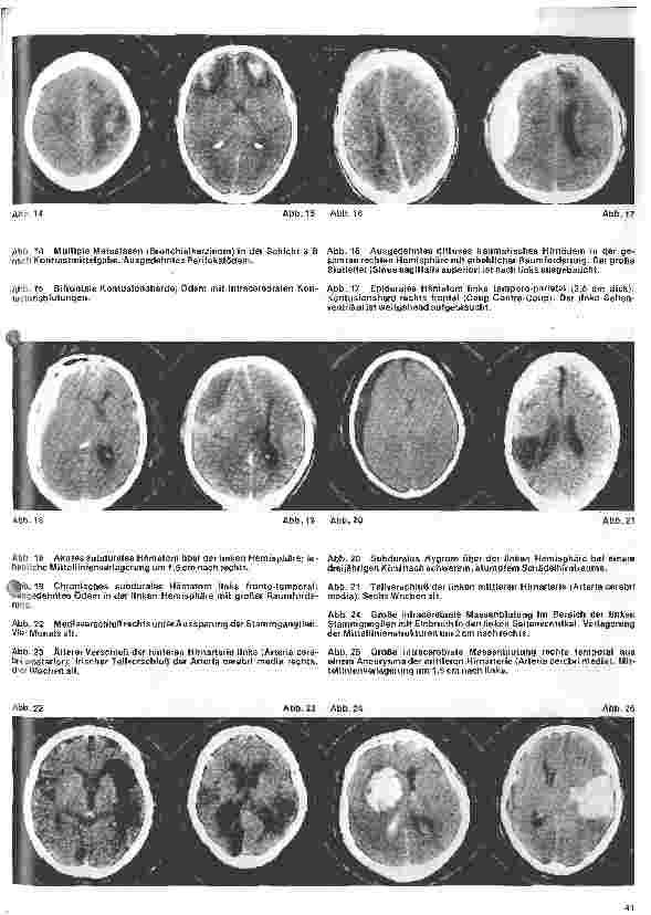 Vorschauseite 4: Themen aus der Neurochirurgie 3. Folge: Die craniale Computer-Tomographie - ein Fortschritt