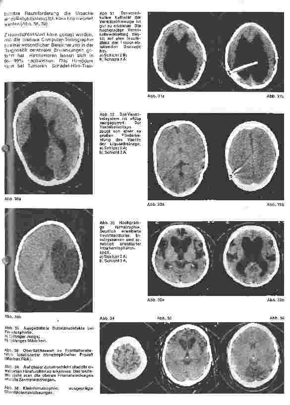 Vorschauseite 6: Themen aus der Neurochirurgie 3. Folge: Die craniale Computer-Tomographie - ein Fortschritt