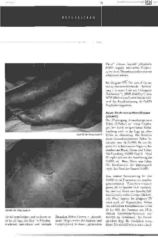 Vorschauseite 3: Einblick in die Knochenmark-/ Stammzelltransplantation (kmt/szt)