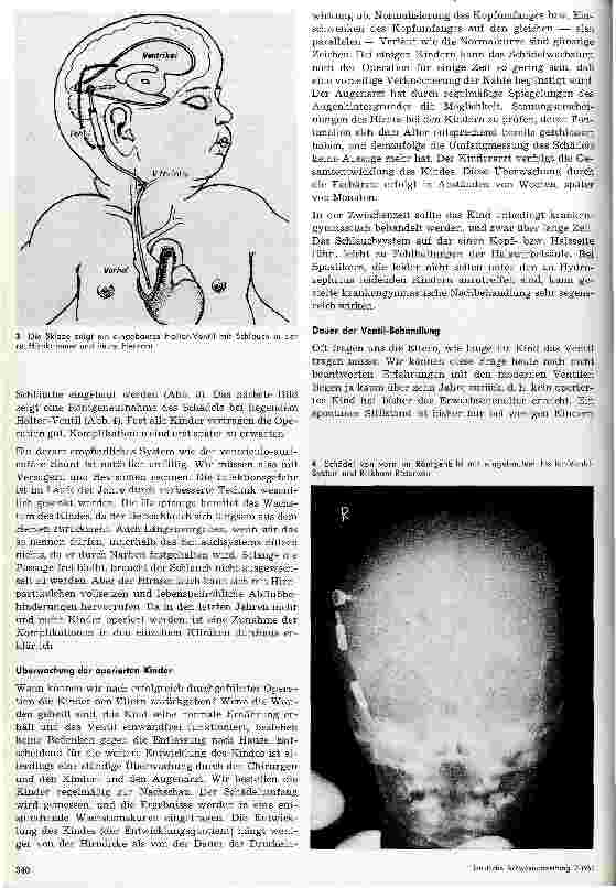 Vorschauseite 4: Der Hydrozephalus