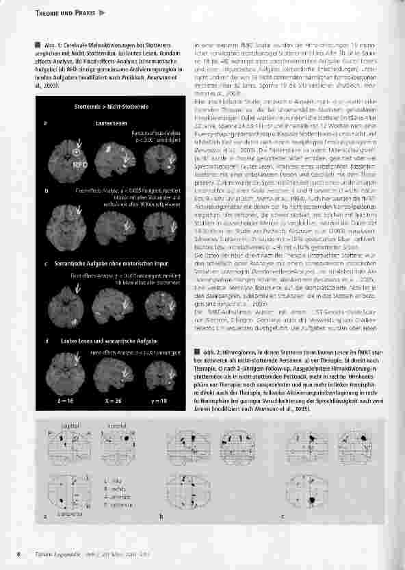 Vorschauseite 3: Stottern im Gehirn: neue Erkenntnisse aus Humangenetikund Neurowissenschaften