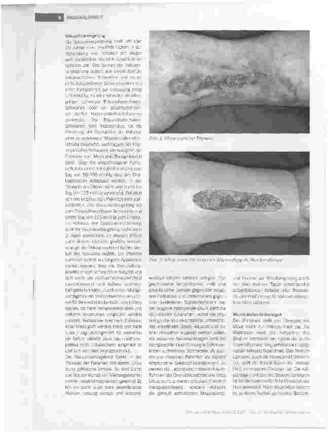 Vorschauseite 3: Wundrandschutz mit Cavilon® während Vakuumversiegelung: Resultate einer klinischen Untersuchung bei Patienten mit Ulcus cruris