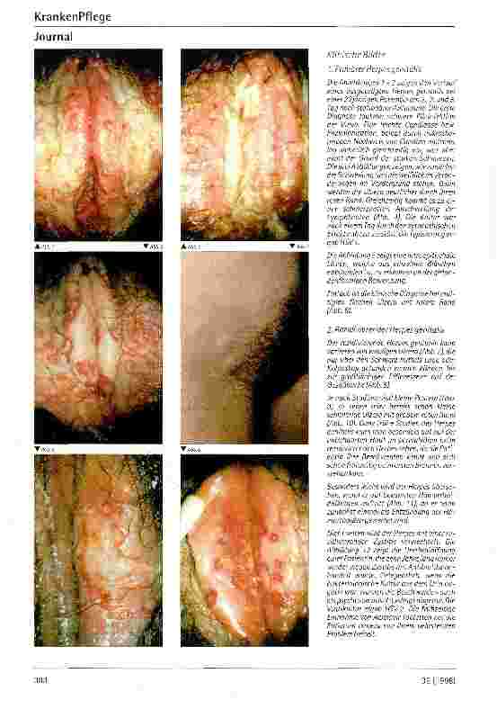 Vorschauseite 2: Therapie des Herpes genitalis