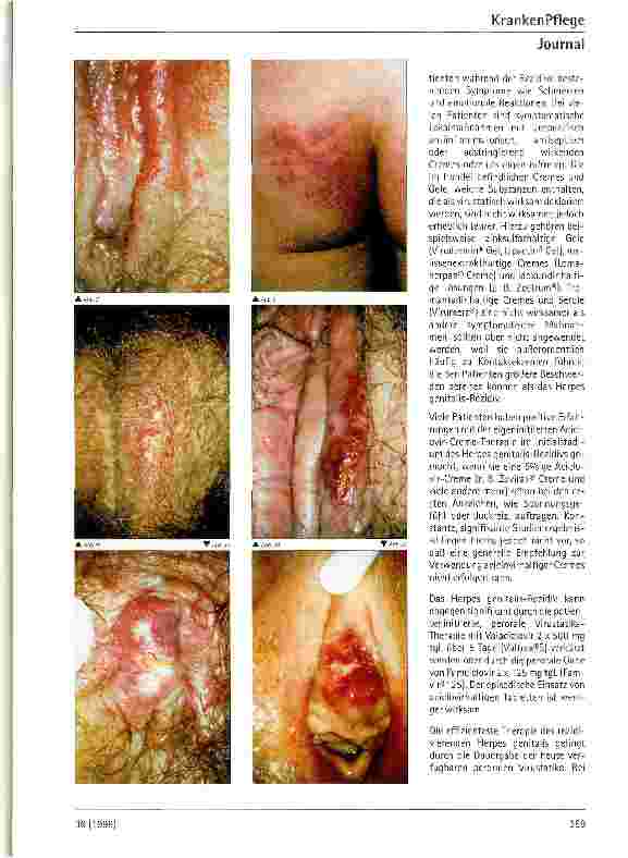 Vorschauseite 3: Therapie des Herpes genitalis