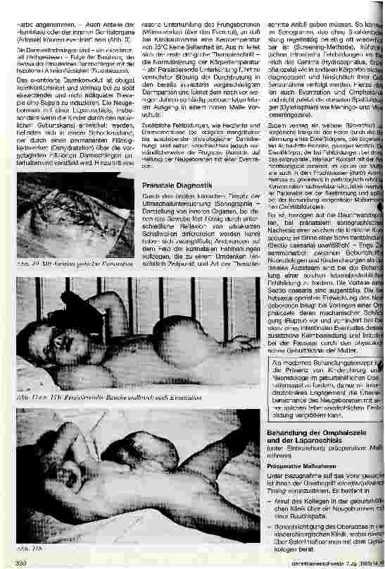 Vorschauseite 3: Angeborene Bauchwandspalten Omphalozele - Eventration