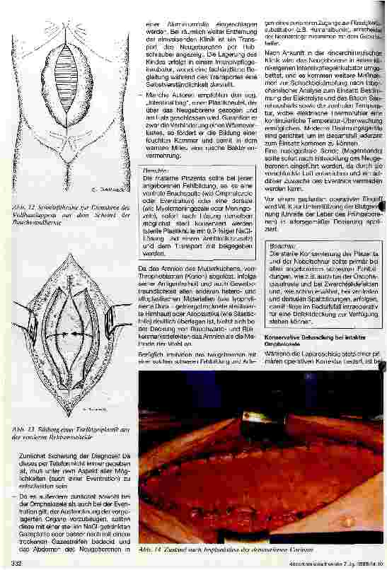 Vorschauseite 4: Angeborene Bauchwandspalten Omphalozele - Eventration