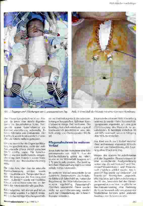 Vorschauseite 3: Präund postoperative Pflege nach Korrektur einer Transposition der großen Arterien