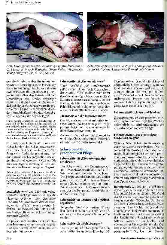 Vorschauseite 2: Die präund postoperative Pflege Neugeborener mit Omphalozele oder Gastroschisis
