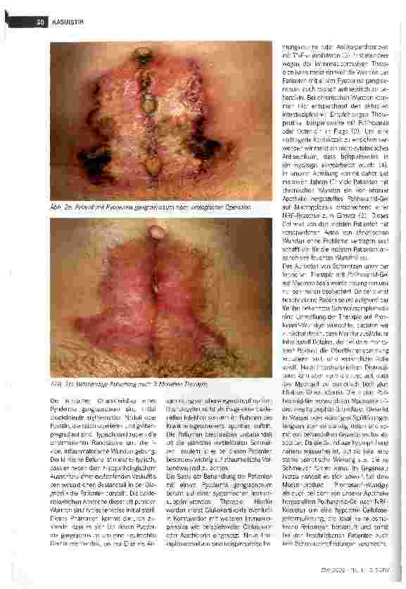 Vorschauseite 3: Schmerzvermeidung durch unterschiedliche Galeniken von Polihexanid-Gelen:Fallbeispiele von Patienten mit Pyoderma gangraenosum