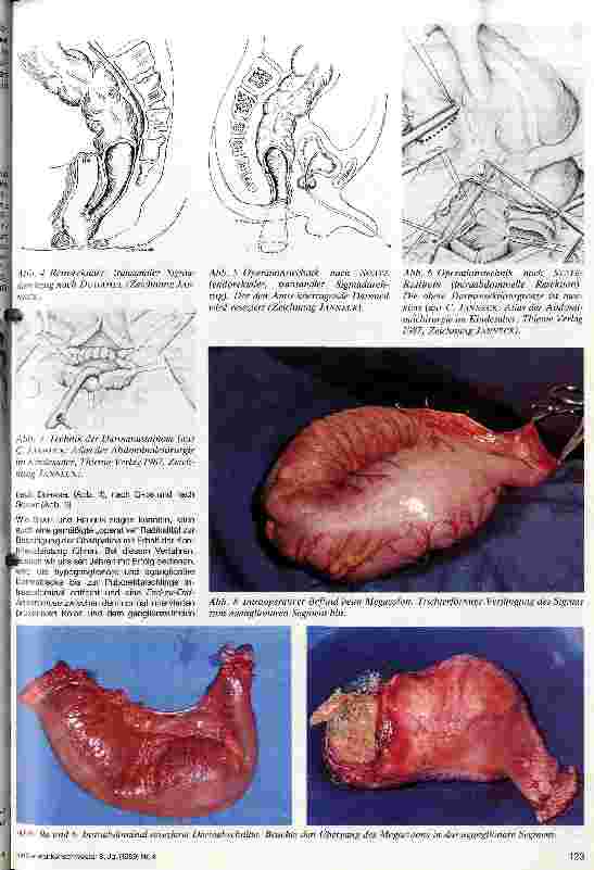 Vorschauseite 3: Megacolon congenitum