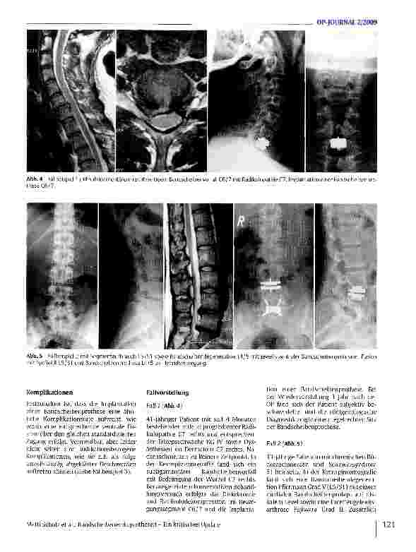 Vorschauseite 4: Bandscheibenendoprothesen - Ein kritisches Update