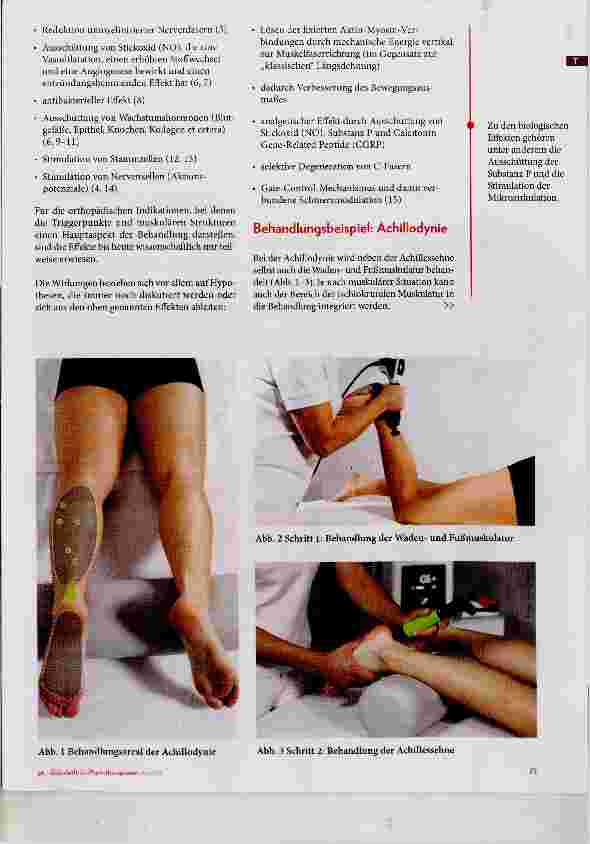 Vorschauseite 2: Myofasziale Stoiswellentherapie als Ergänzung in der Physiotherapie? Chancen und Grenzen der Methode