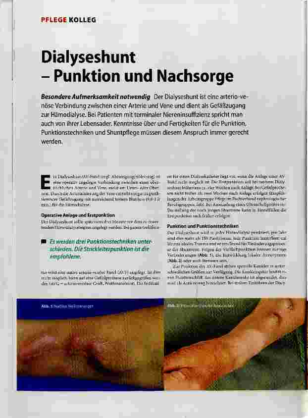 Vorschauseite 1: Dialyseshunt- Punktion und Nachsorge