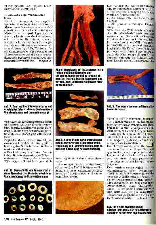 Vorschauseite 3: Arteriosklerose - ihre Ursachen und Folgen