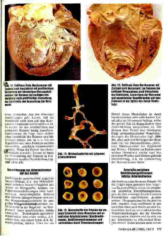 Vorschauseite 4: Arteriosklerose - ihre Ursachen und Folgen