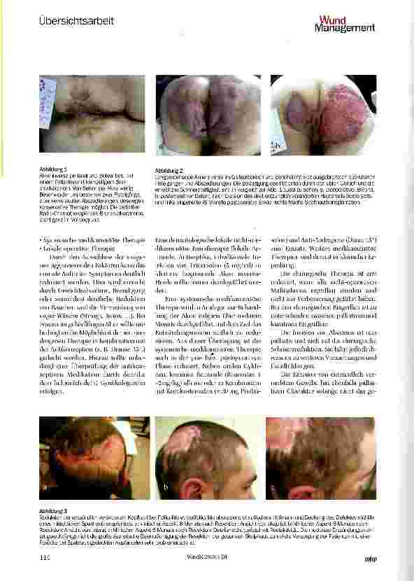 Vorschauseite 3: Multidisziplinäre Therapie der Akne inversa