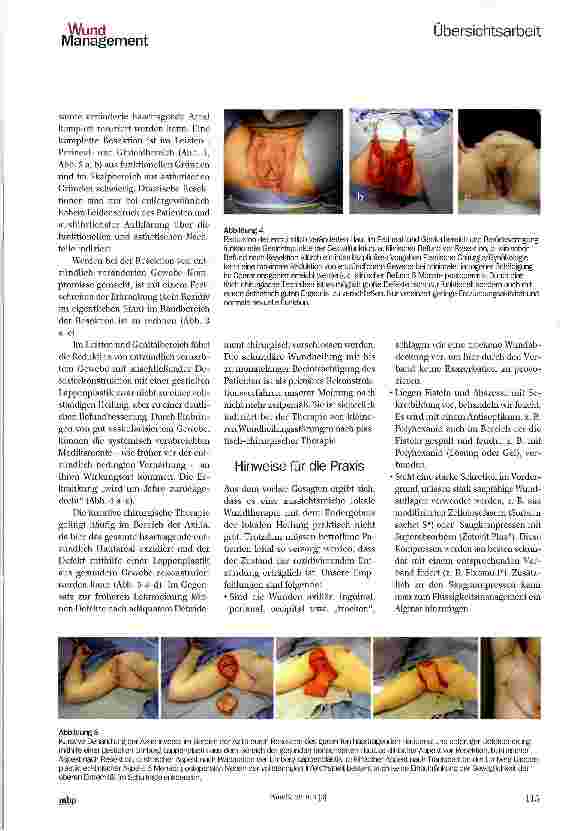 Vorschauseite 4: Multidisziplinäre Therapie der Akne inversa